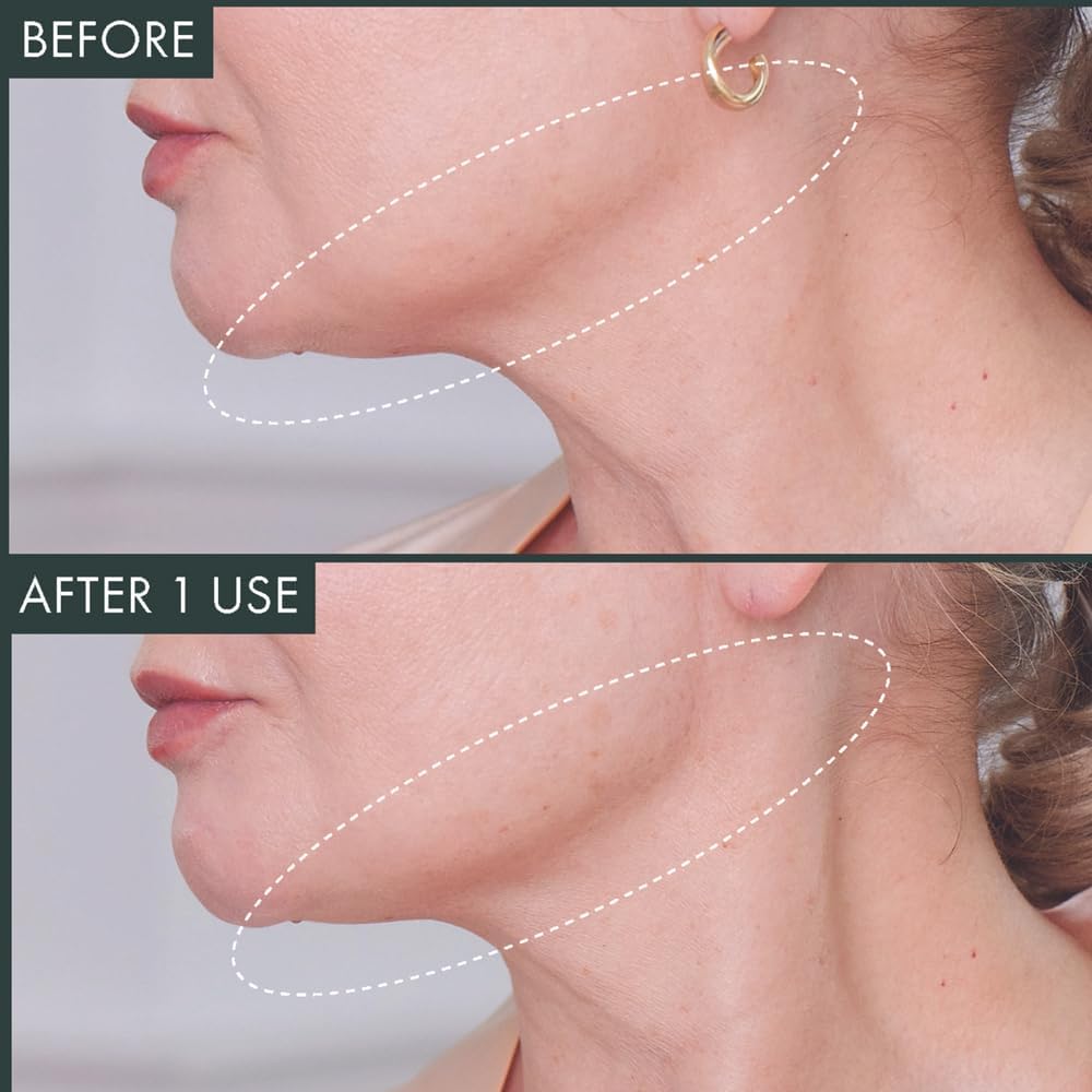 RéVive Neck & Chin Mask - Fermitif Jawline Shaper to Help Sculpt, Tone & Define Neck and Facial Skin - Helps to Improve the Appearance of Fine Lines, Wrinkles & Skin Texture (6 Count)