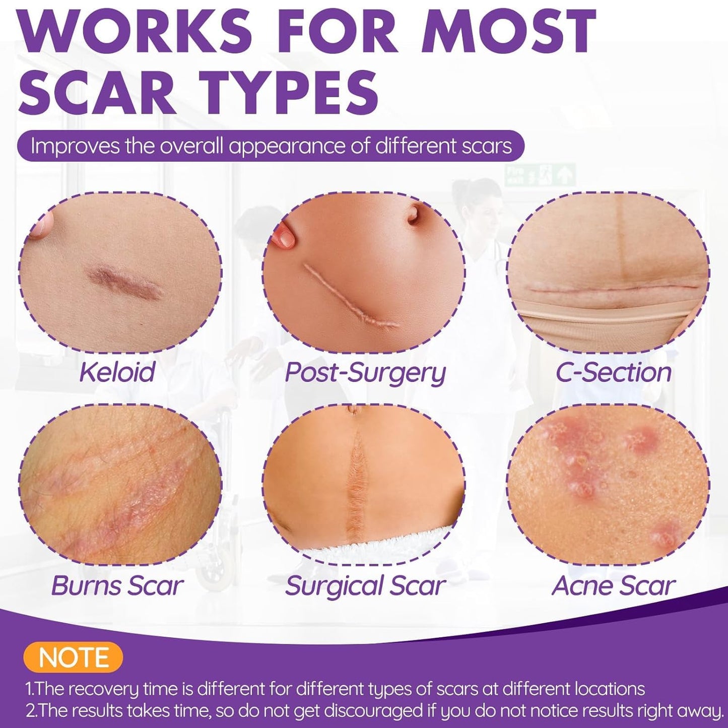Silicone Scar Sheets, Silicone Scar Tape(1.6"x 118" Roll-3M)
