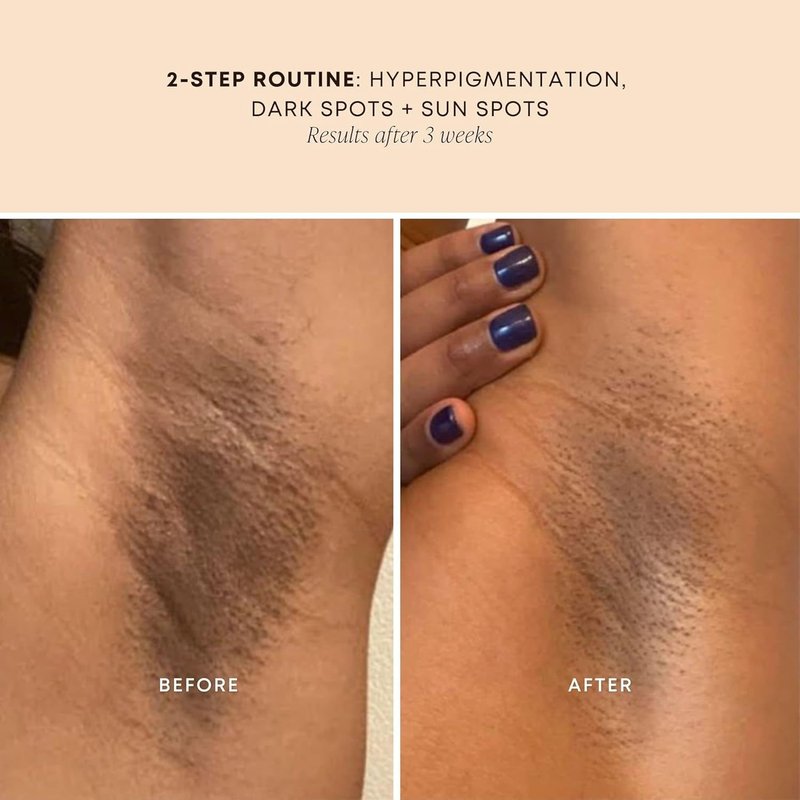 Dark Spot Oil - Reduce Dark Spots & Ingrown Hairs, Hydrating Skin Treatment - 30ml Bermuda