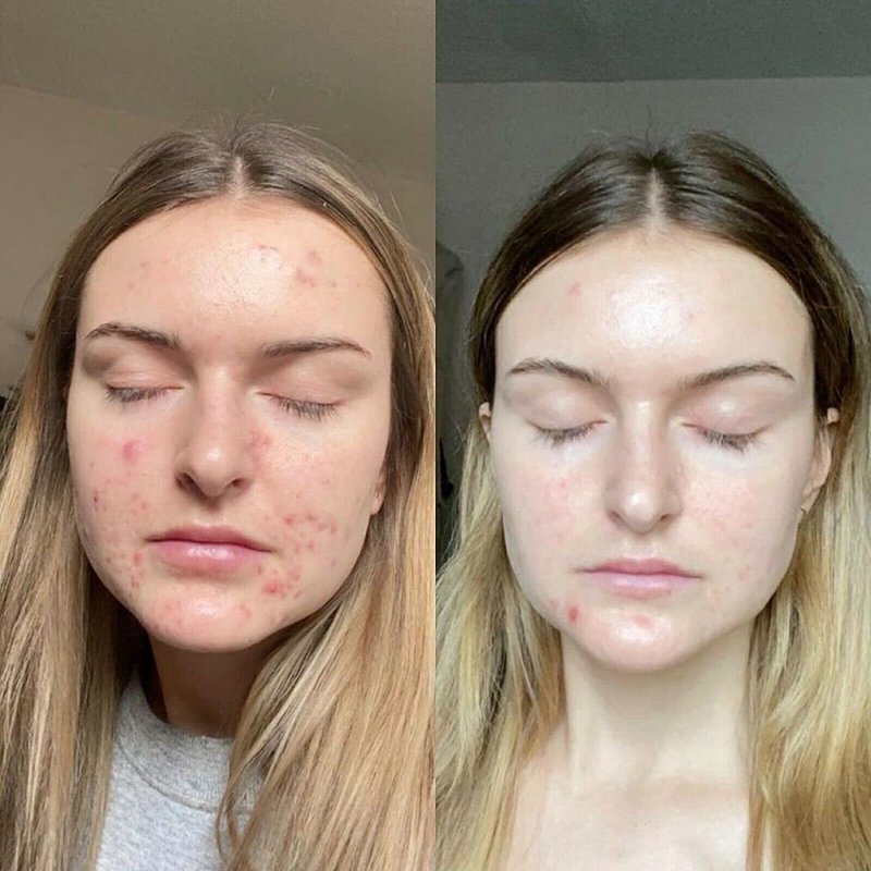 Retinol Gel 0.1% - Anti-Aging Treatment for Fine Lines, Wrinkles & Scars | 20 Grams