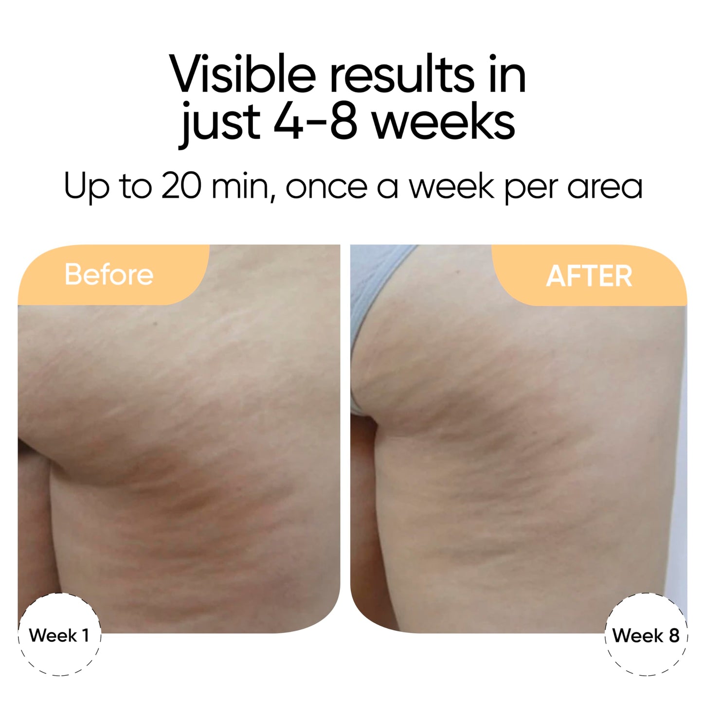 Sensica Sensifirm Patented Radio Frequency Skin Tightening Device for Body – RF Body Sculpting Tool for Thighs & Buttocks, Firming & Smoothing, Cellulite Remover For Legs, At-Home Skincare Machine