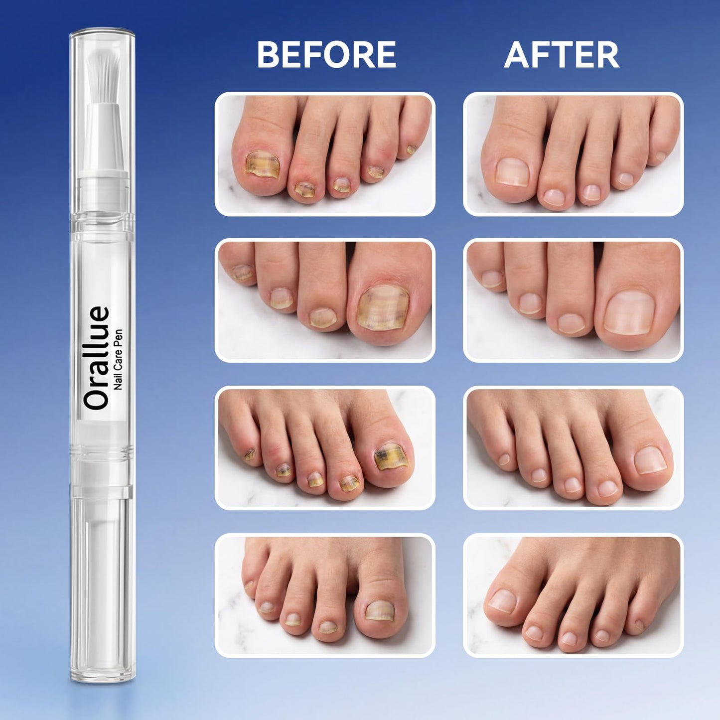 4PCS Nail Care Pen – Daily Nail & Cuticle Care for Improving the Look of Discolored Nails, 4 x 3ML