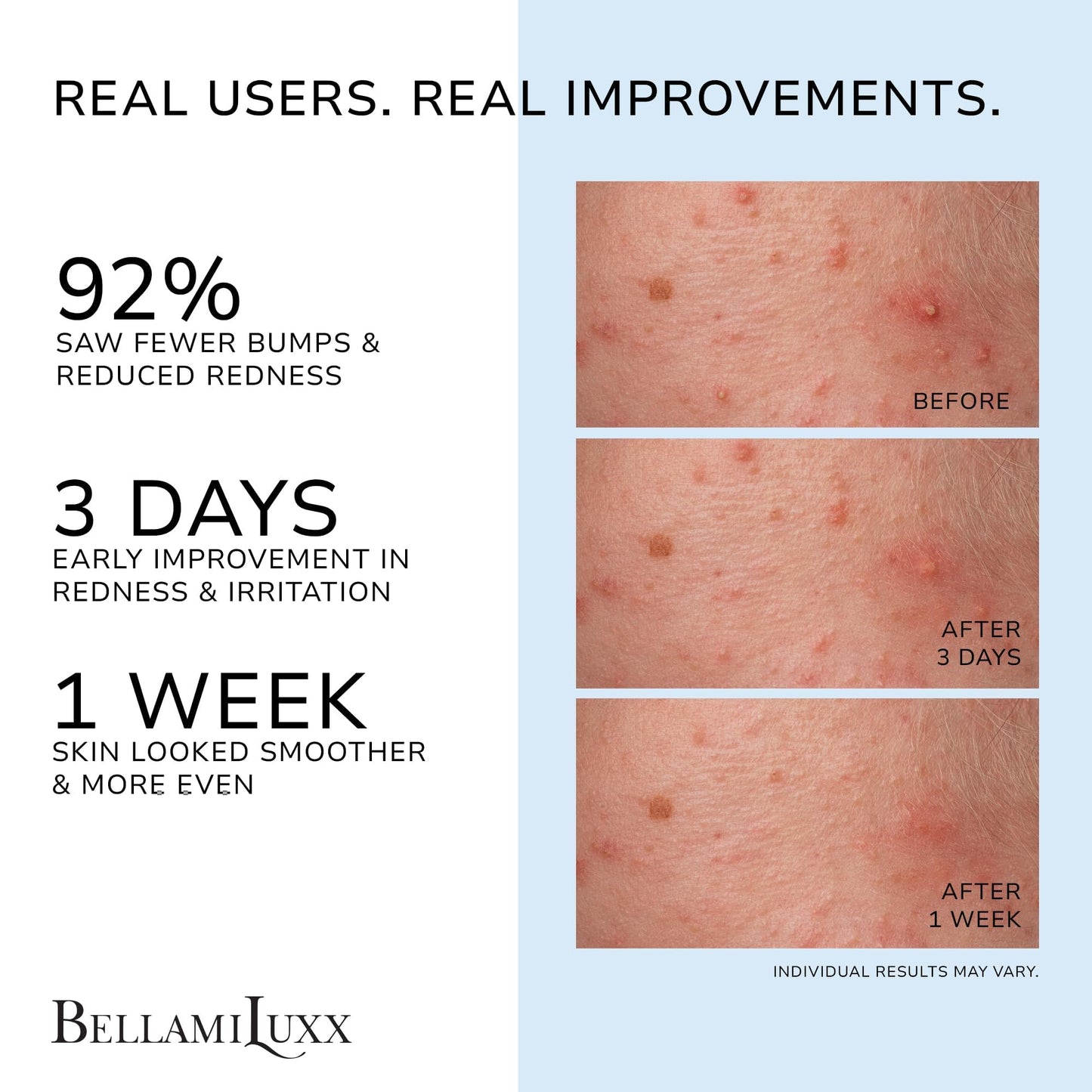 BellamiLuxx Folliculitis Acne Lotion for Body: Helps Reduce Itch, Redness, Body Acne, Bumps & Uneven Texture with Salicylic & Glycolic Acid + Botanicals - Gentle Care for Folliculitis-Prone Skin