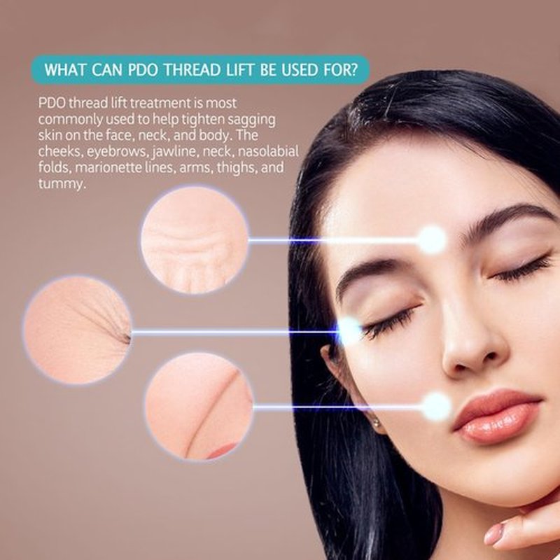 ESTEVO PDO Mono Threads Lift, for Face and Body PDO Thread For Skin Tightening and Reduce Wrinkle (20PCS-29G*50mm)