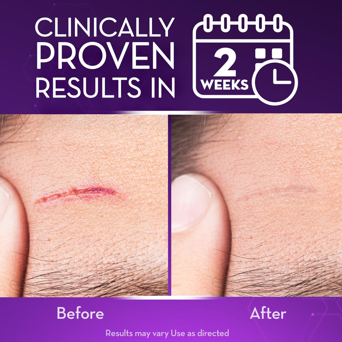 Cicatricure Advanced Scar Gel, Proven Results in 2 Weeks, 1 oz (28 g)