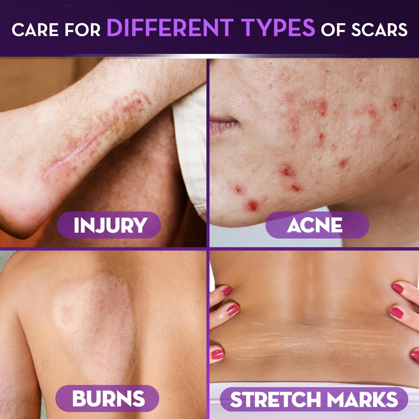 Cicatricure Advanced Scar Gel, Proven Results in 2 Weeks, 1 oz (28 g)