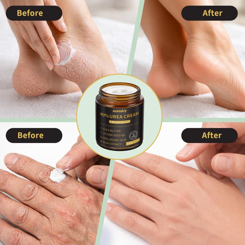 Annsky Urea Cream 40% Plus Salicylic Acid 2%, Foot Cream for Dry, Cracked Heels, Calluses Professional Feet Maximum Strength Moisturizing Cream, 155g
