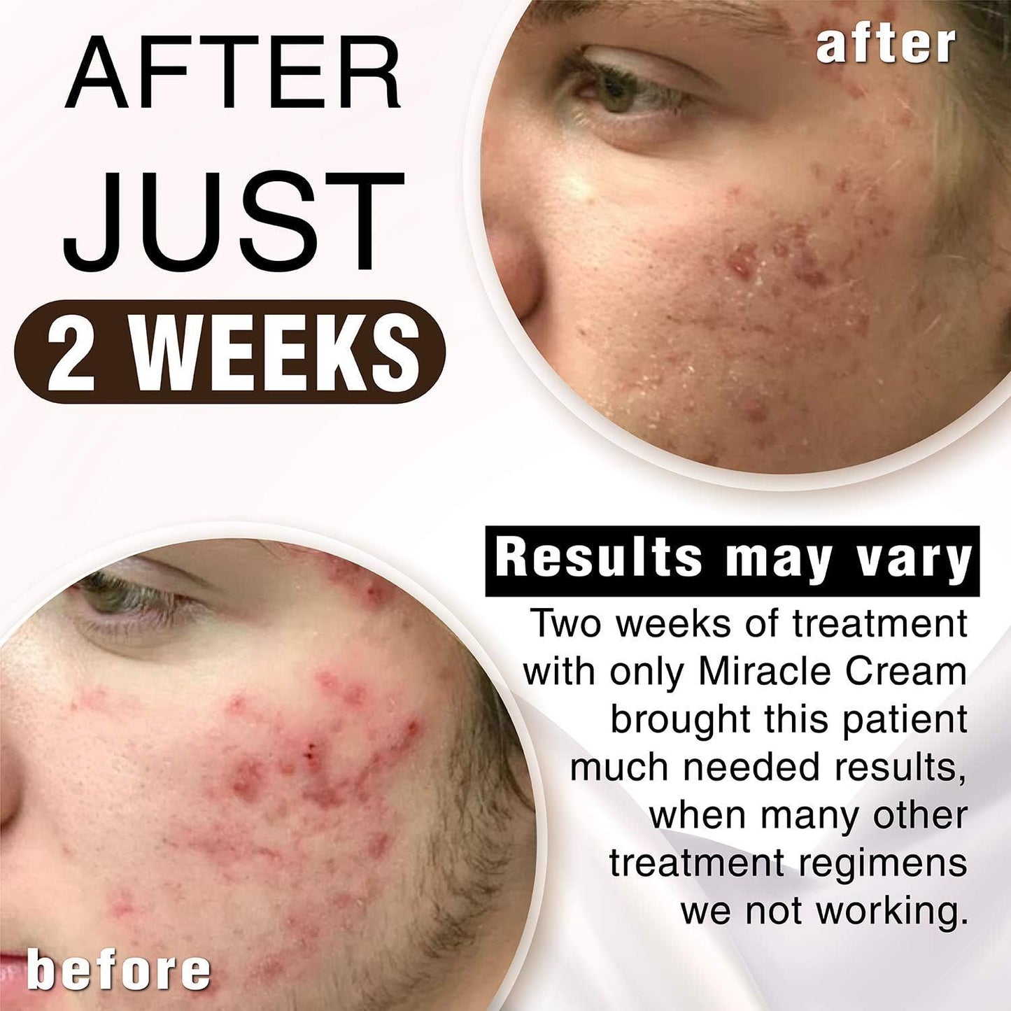 Anna Guanche MD Miracle Cream - Acne Treatment that Quickly Reduces Pimples & Redness .5mL