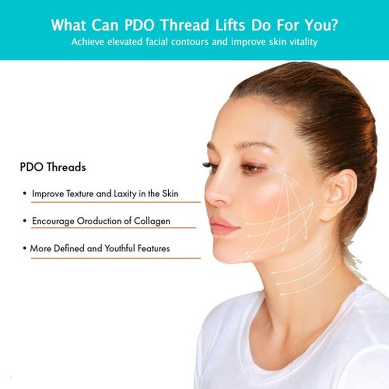 ESTEVO PDO Screw Thread, Lift Face Tip Screw Threads, PDO Threads Face Lifting Face & Whole Body (100PCS-29G*25mm)