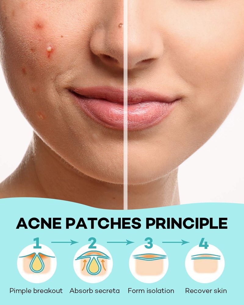 Acne Patches - Hydrocolloid Pimple Patch with Tea Tree & Calendula Oil | 560 Invisible Zit Patches in 4 Sizes