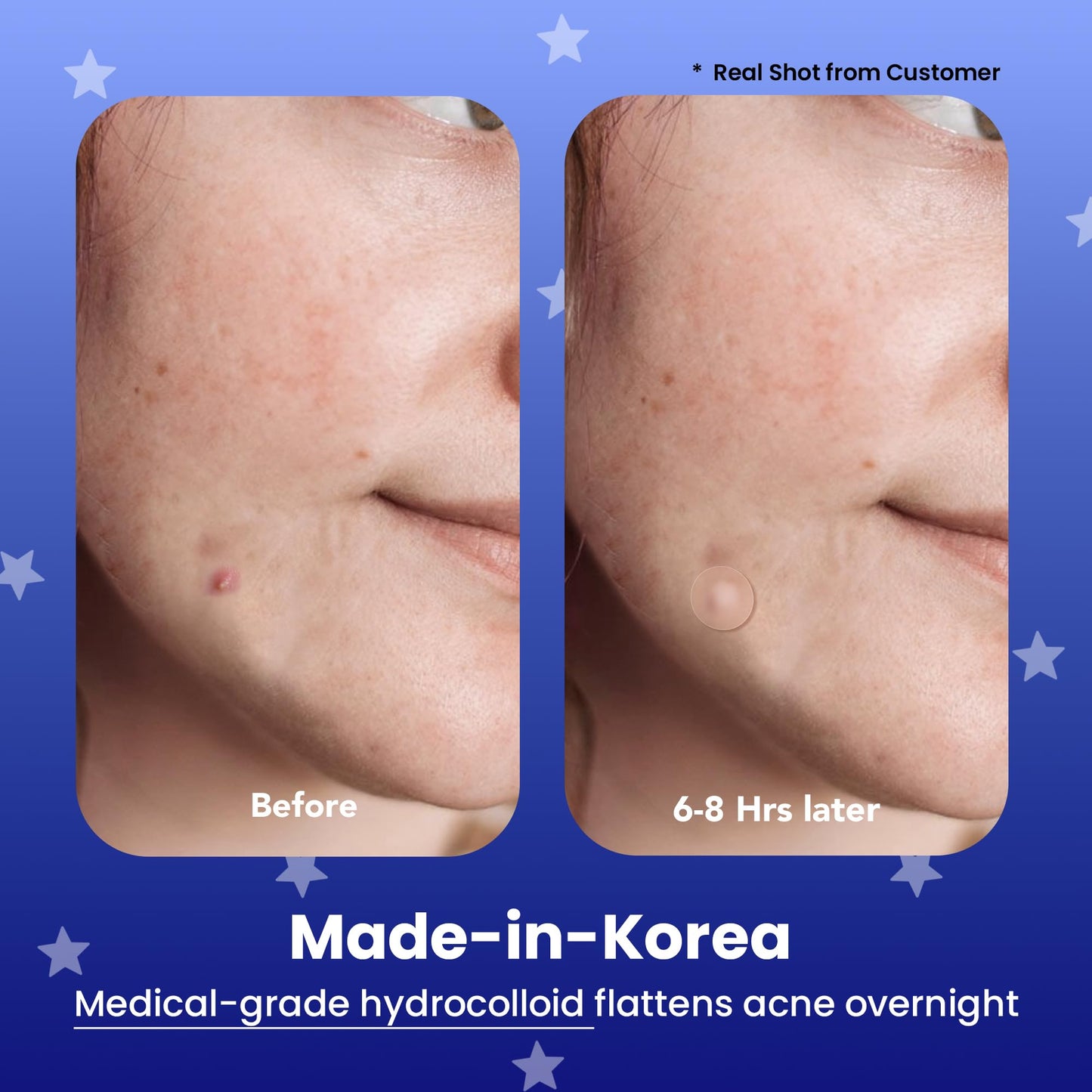 AVARELLE Spot Pimple Patches for Face | Good Night Acne Cover | Hydrocolloid with Tea Tree Oil | Acne Spot Treatment (12-14 mm, 24 ct)