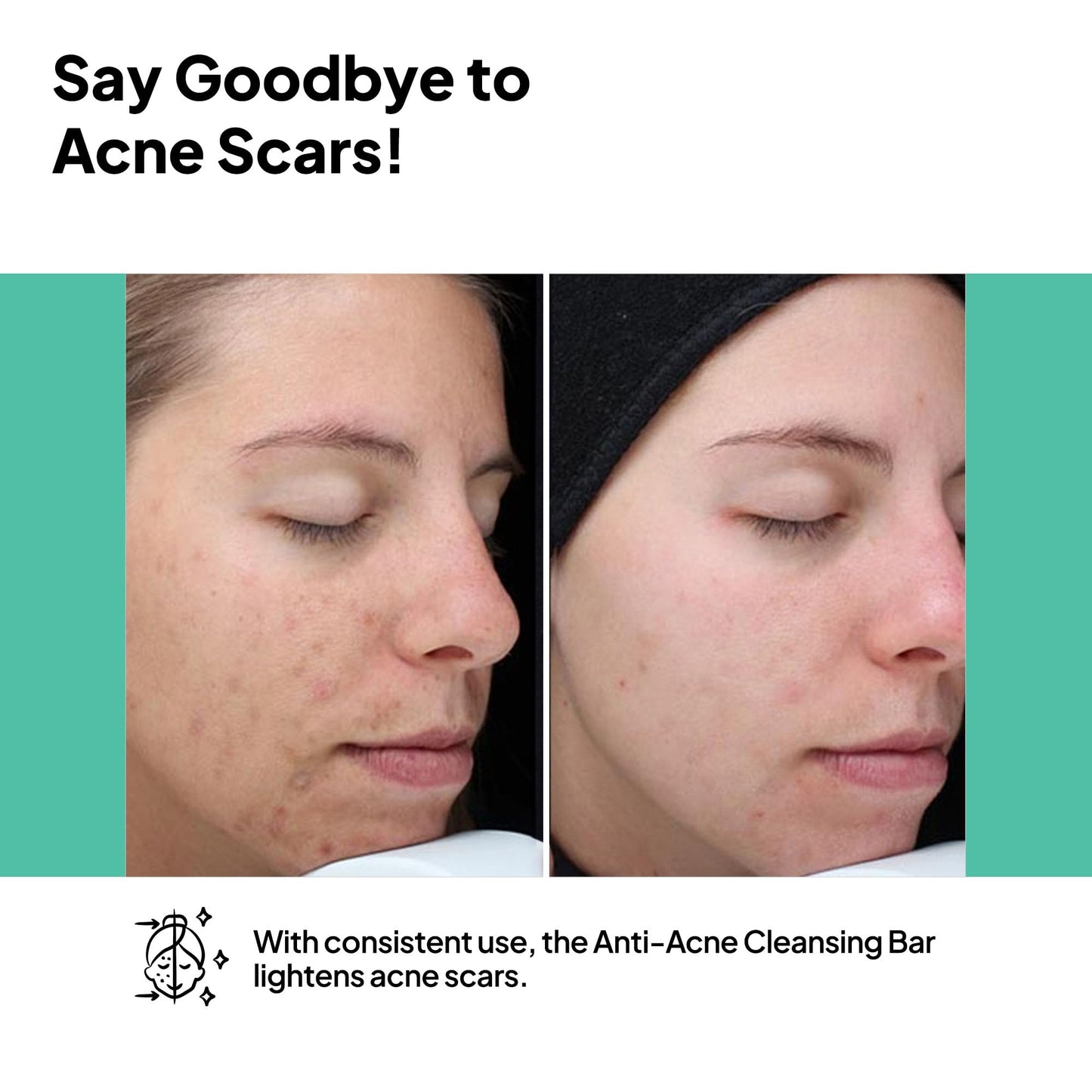 PhLab Acne Cleansing Bar, Body Exfoliating Bar Soap for Face, Chest and Back, Pimple and Bacne Treatment Bar Soap for Acne Prone Skin, 1.76 Oz (1)