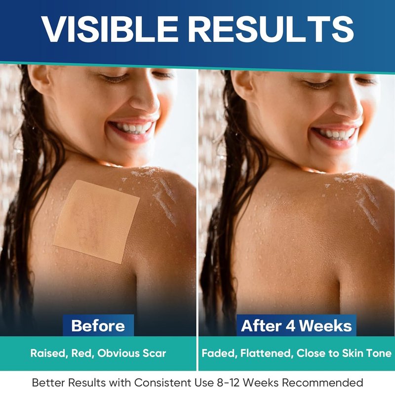 Medical Grade Silicone Scar Sheets - Advanced Treatment for Surgical, Burn & Keloid Scars | Flexible 4"x4" Strips