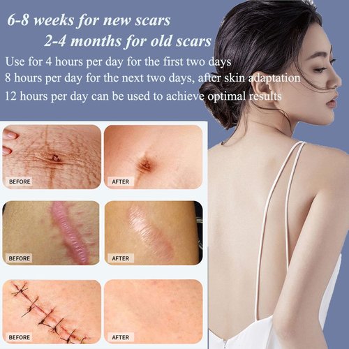 Medical Grade Silicone Scar Sheets 1.6"x 157" Roll-4M Keloid Scars Removal C-Section Scar Strip Painless Treatment Resuable Tummy Tuck Tape Professional for Surgical Incision,Acne,Burn Scar