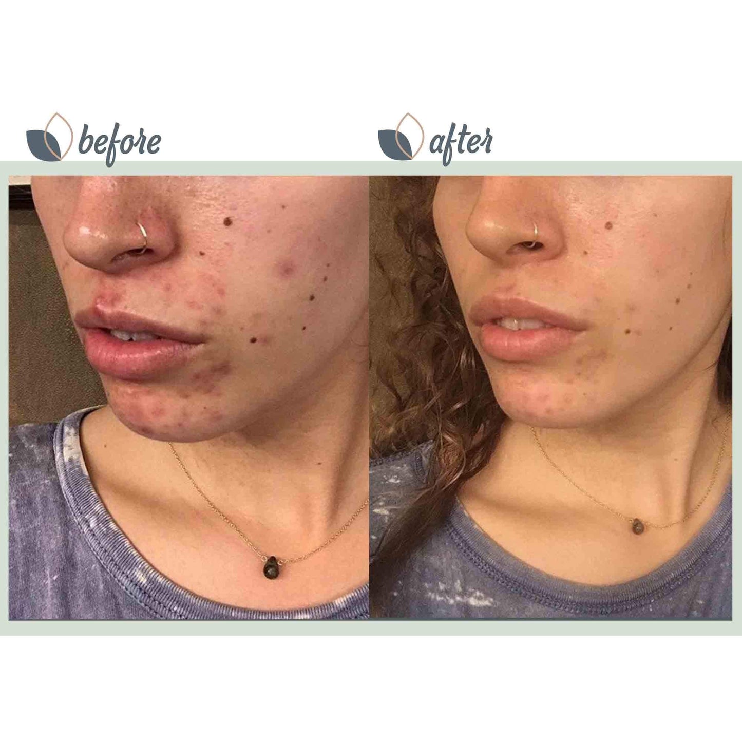 BioClarity 3-Step Acne Routine, Mini Size, for Oily or Acne-Prone Skin, Clean Vegan Ingredients, Includes Cleanser, Salicylic Acid Acne Treatment Gel, Restorative Green Gel
