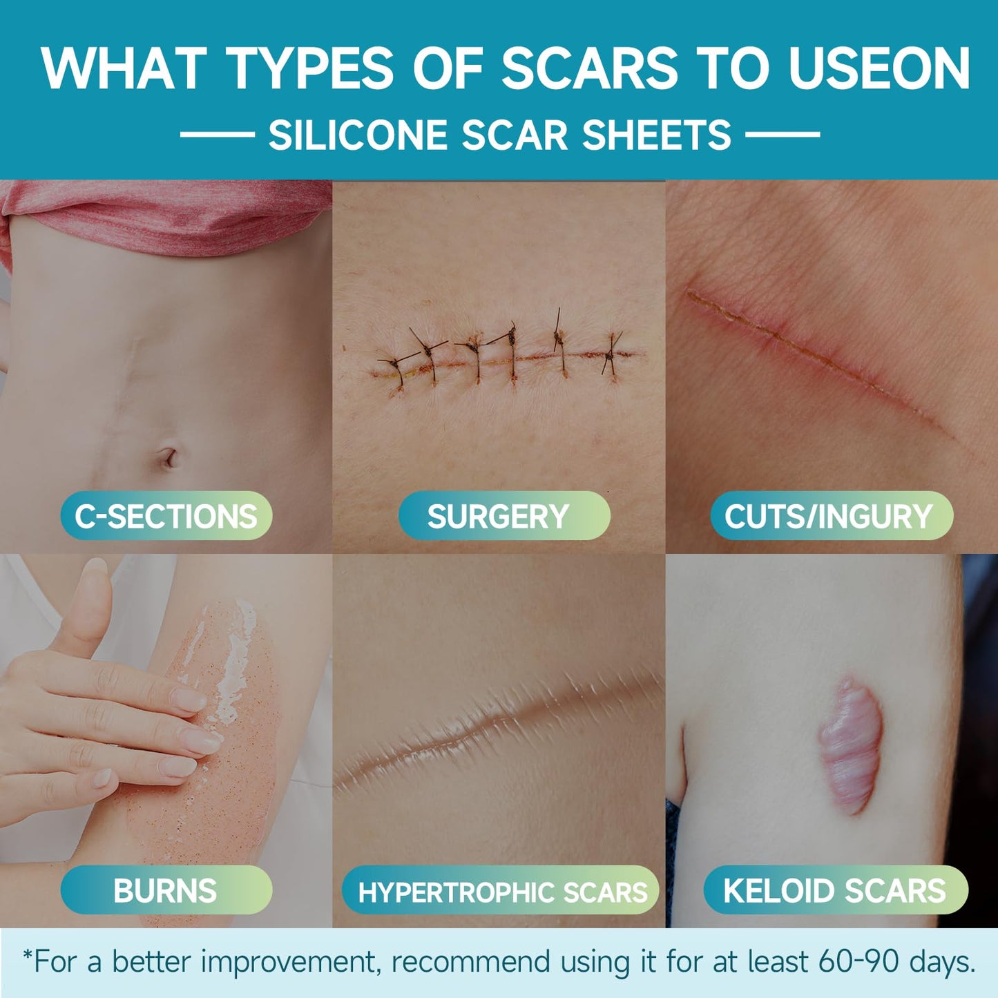 Silicone Scar Sheets, Silicone Scar Tape (1.6"x60 " Roll-1.5M) Reusable Professional Scar Silicone Strips Soft Silicone Scar Patches for Scar Removal Treatment, Surgical Scars, Keloid, C-Section, Burn
