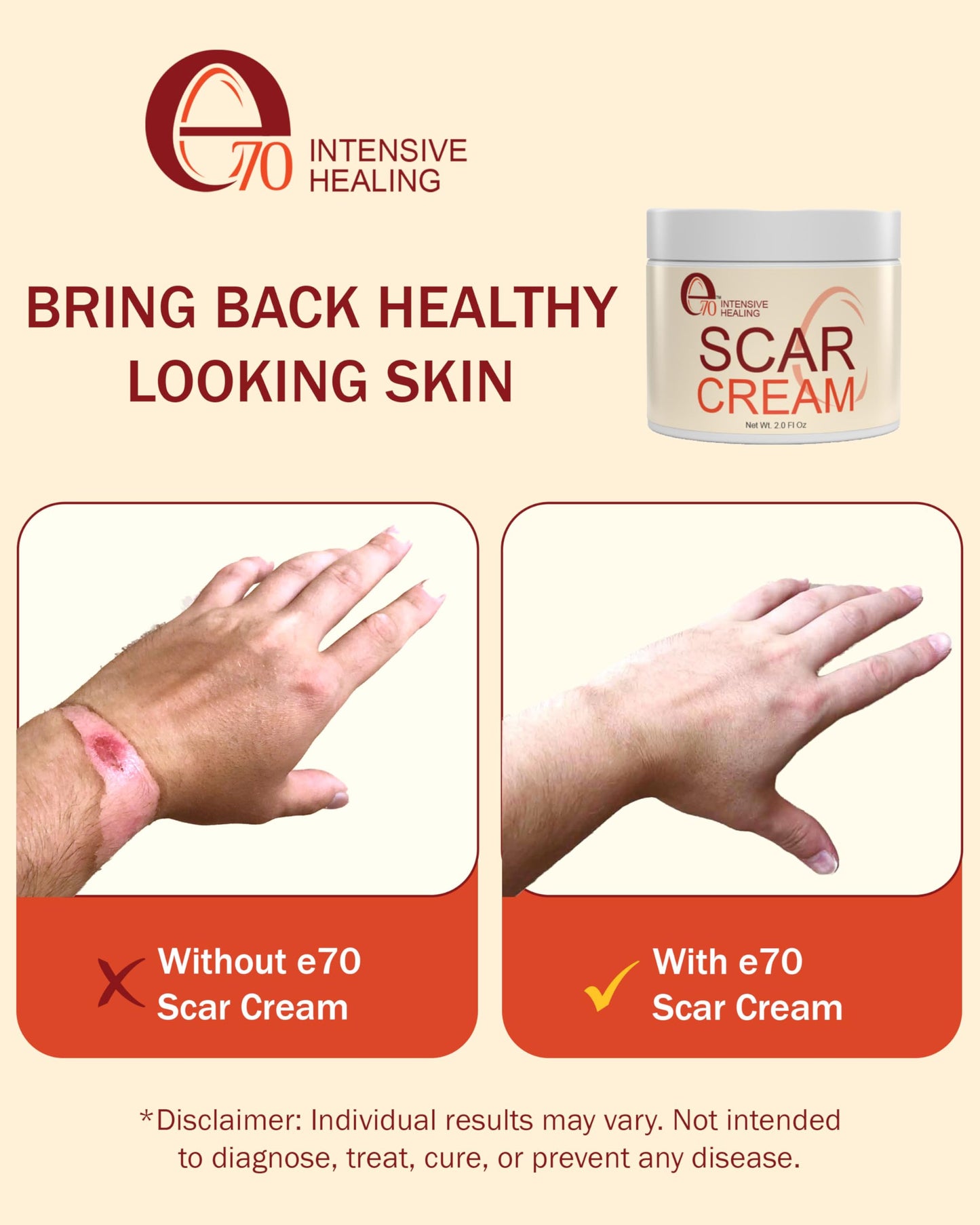 Scar Cream Gel for Surgical Scars Fast Repair C-Section -2.0 Fl Oz , Stretch Marks, Keloids, Burns, Scar Away Cream for Old Scars. Vitamins Full - All Skin Types - Reduce Acne Spots and scar treatment