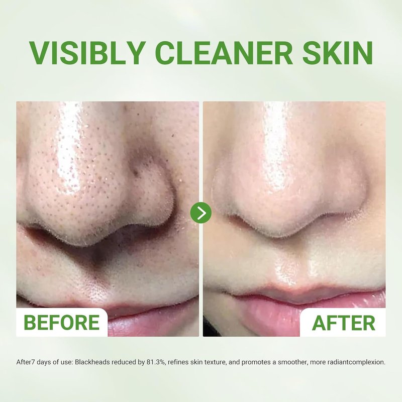 Acid Clay Mask - Deep Cleansing Facial Skincare with Amazonian White & Glacier Clay | Pore Minimizing, Oil Control, 3.53 oz
