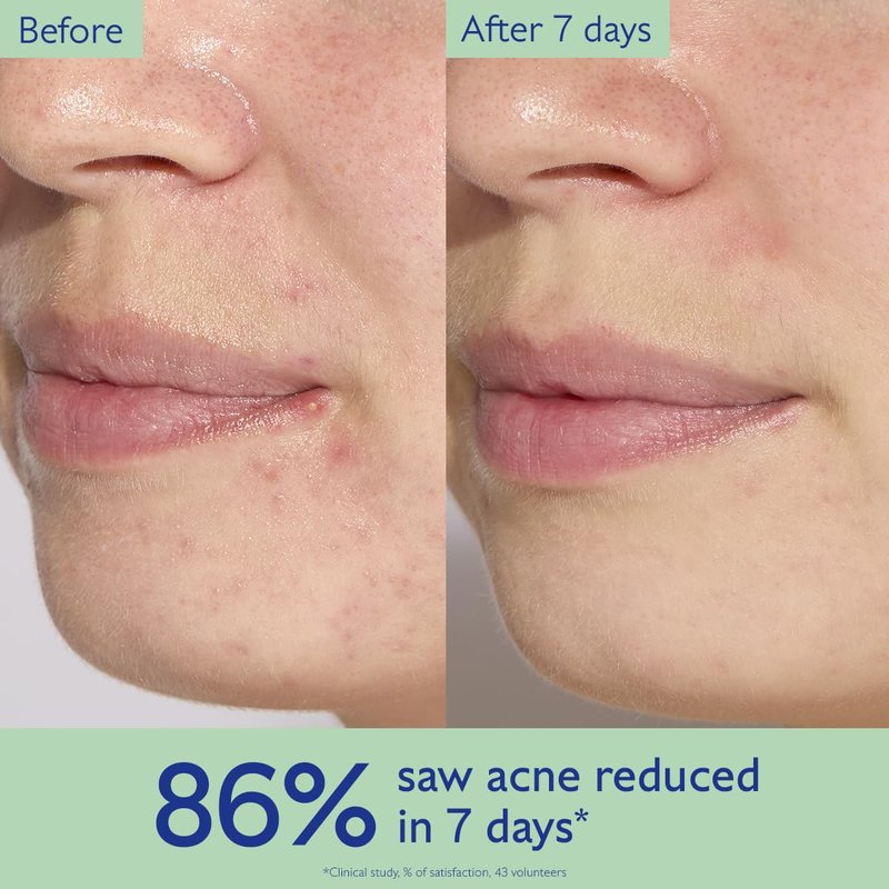Caudalie Vinopure Acne Serum - Target Blemishes & Prevent Breakouts | 1.0 oz + 2 Travel Sizes