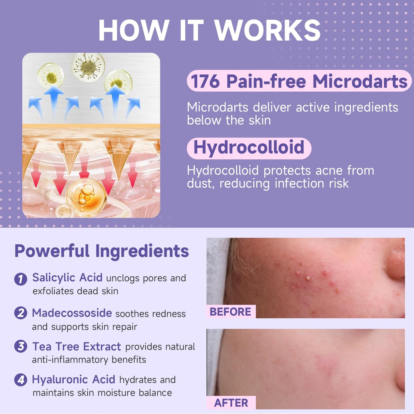 TEAWOO 36-Count Microdart Acne Patches, Cute Pink Round-shaped, Hydrocolloid Pimple Patches with Salicylic Acid & Madecossoside, Microdart Zit Patches for Deep Blemishes & Early Stage Acne (Patented)