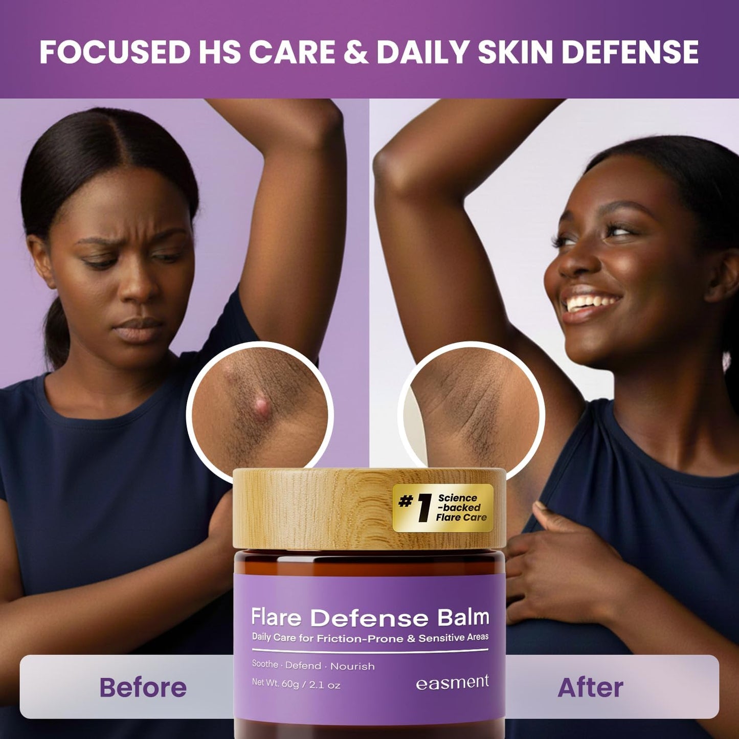 Hidradenitis Suppurativa Flare Defense Balm Cooling Formula: 2oz Daily Protection for Flare-Prone, Bump-Prone, Friction-Prone Skin – Non-Greasy, Non-Staining – Microsilver BG™, Zinc Oxide & Botanicals