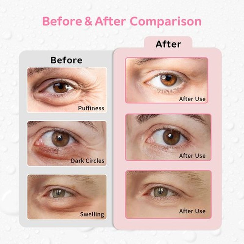 CONBELLA Gel Ice Pack Reusable Cooling Eye Pads and Under Patches,Eye Hot Cold Treatment for Redness,Pain Relief Relax (Butterflies)