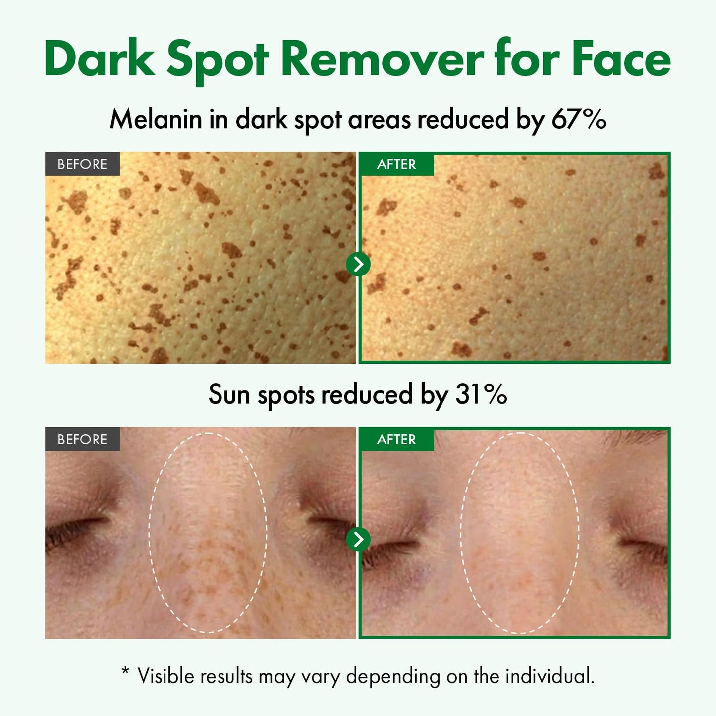 TOSOWOONG Dark Spot Correcting Serum for Dark Spots & Dull Skin, Freckles