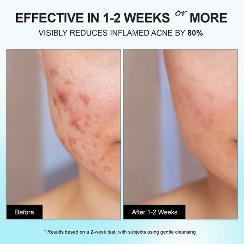 Cystic Acne Spot Treatment Cream for Face, Back and Body, with 10% Azelaic Acid & 2% Salicylic Acid, Hormonal Pimple Moisturizer for Teens & Adults, Relief Breakouts Redness Swelling, 1.8 oz