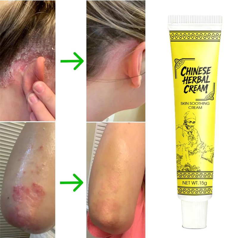 Smiles and Joys Herbal Cream, East Asian Natural Herbal Cream, Herbals Ointment for Natural Relief of Skin Problems for All Skin Types