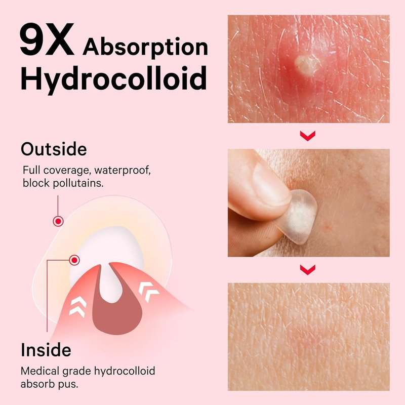 Sosky Pimple Patches - Hydrocolloid Acne Treatment with Salicylic Acid | 24 Count Invisible Zit Stickers