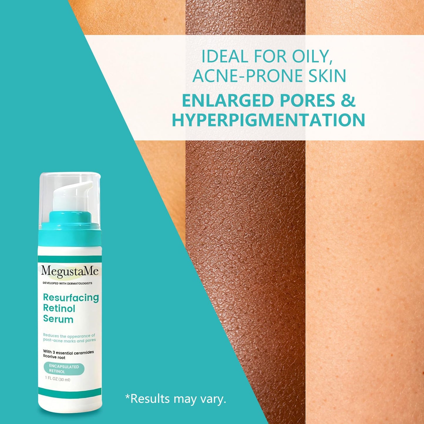 MegustaMe Resurfacing Retinol Serum for Acne Scars & Pores, 30ml. Encapsulated Retinol for Sensitive Skin, Gentle Anti-Aging with Less Irritation. Dermatologist-Developed.