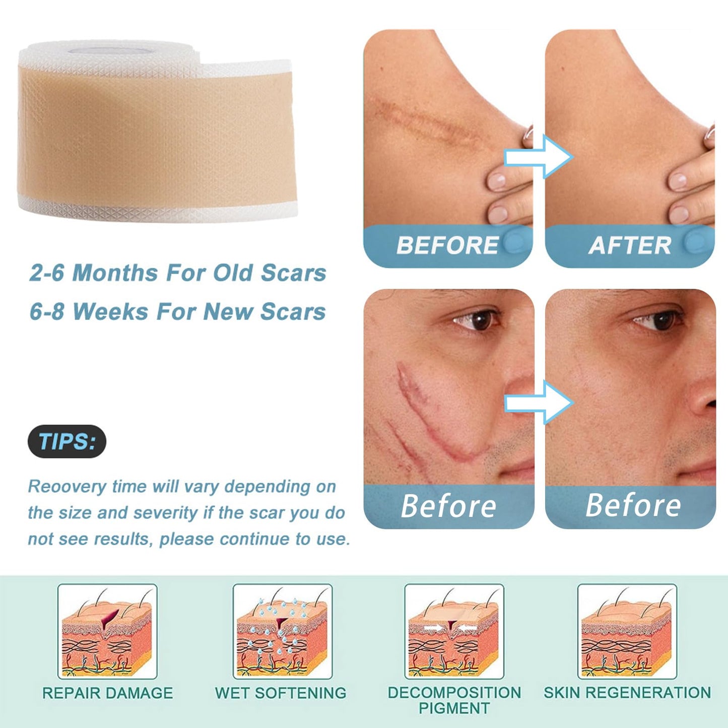 Silicone Scar Sheets, Self-Adhesive Scar Tape, Silicone Sheets For Scars, Scar Tape For Surgical Scars, Keloid Bump Removal, Cesarean Surgery Scar Removal(1.6"x 118" Roll)