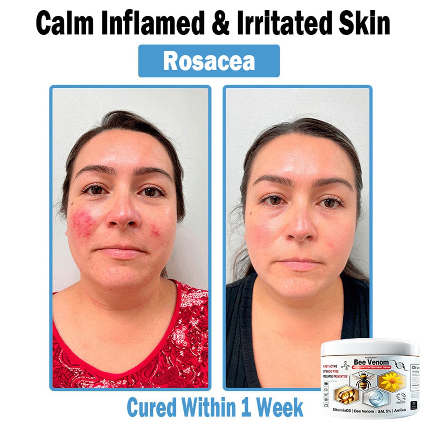 TODAHOF Bee Venom Multi Symptom Skin Treatment Cream, Professional Bee Venom Cream, TODAHOF Bee Venom Skin Treatment Cream, for All Skin Types (1 Bottle)