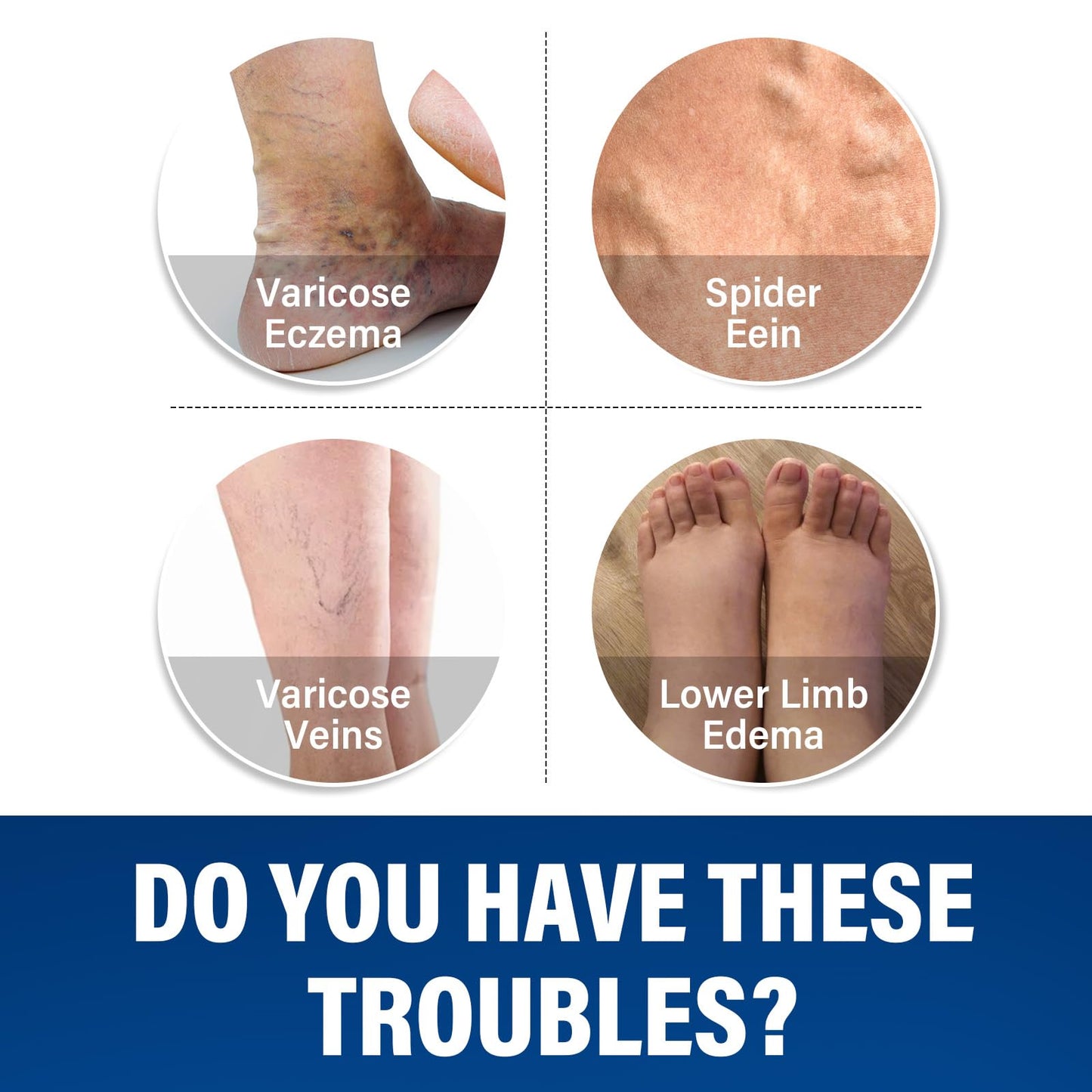 CURECURE Varicose Veins Treatment for Legs, Varicose Veins Treatment Cream- Improves Blood Circulation, Reduces Varicose Veins and Heaviness, 2 Count