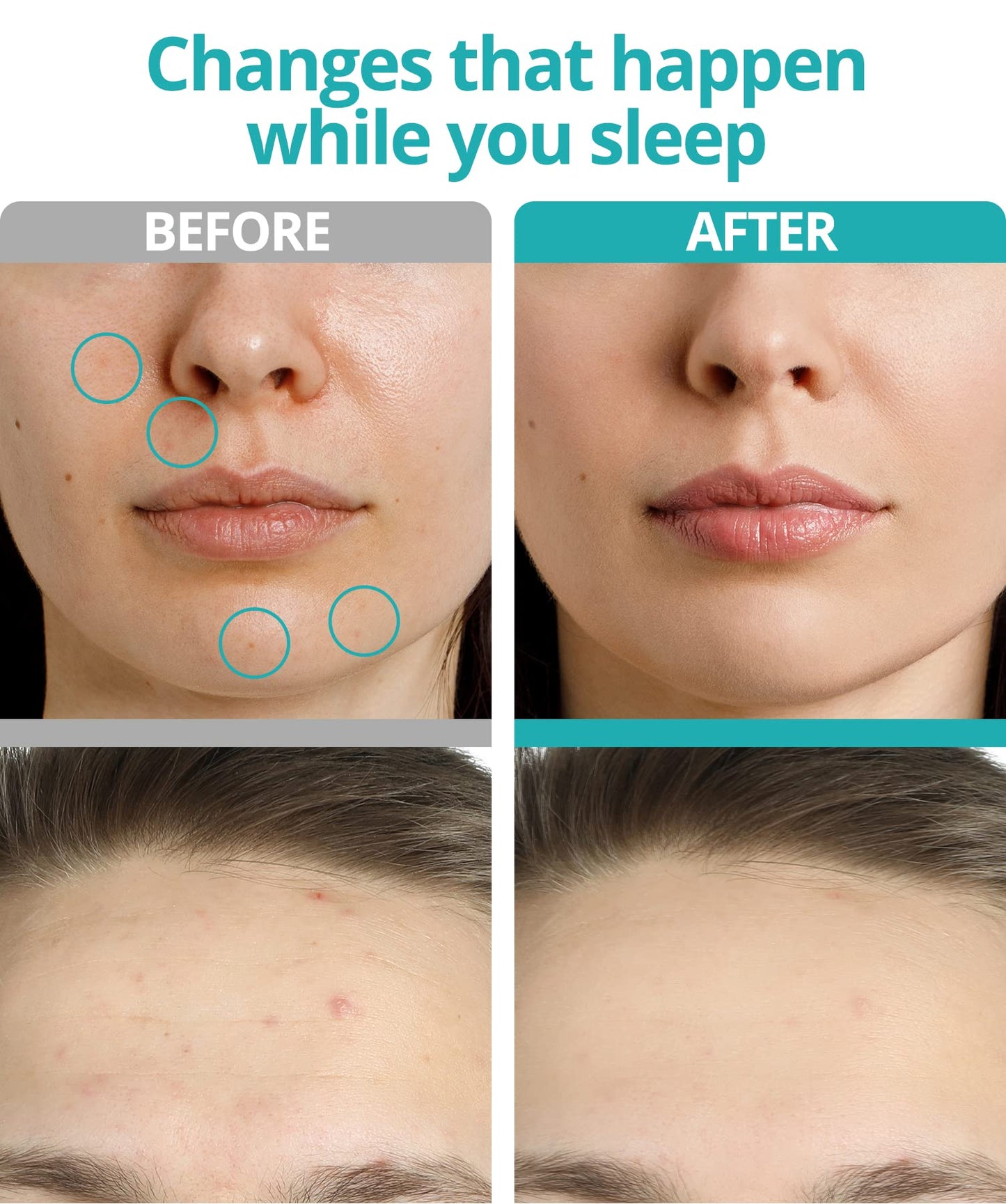 VILVIN Microdart Acne Patch for Deep Blemish - 9 Patches - Dark spot remover for face - Fast Acting Microdart Pimple Patches for face - Hyaluronic Acid, Tea Tree