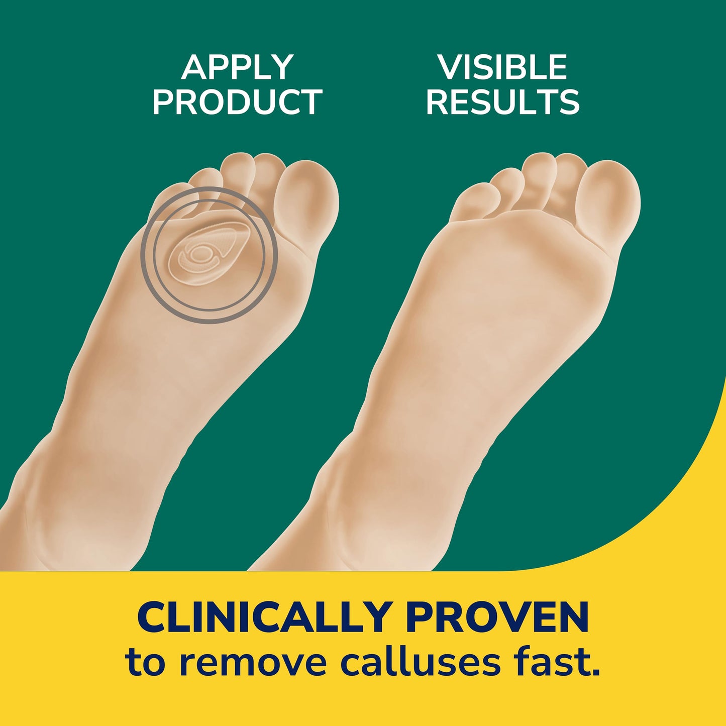 Dr. Scholl's Duragel Callus Remover 12 Count