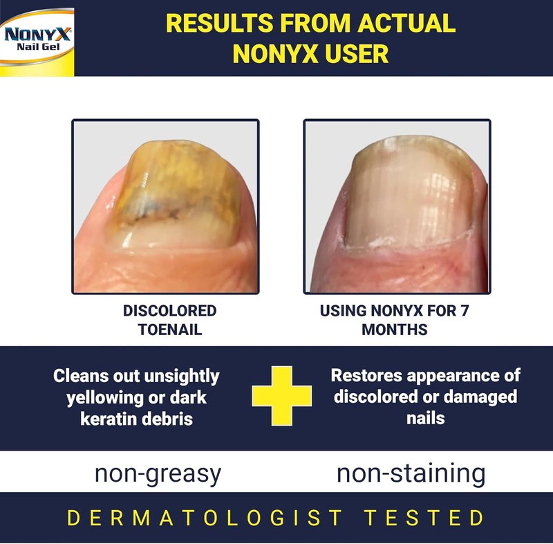 NONYX Fungal Nail Clarifying Gel - Clinically Proven Treatment for Discolored, Thick, and Brittle Toenails | 90% Improvement Rate