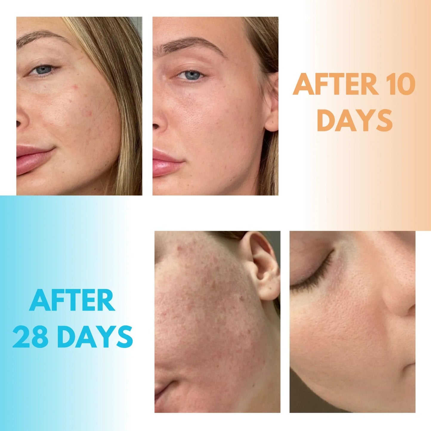 Kanzen Skincare Derma Acne Duo Set Acne Cleansing Water & Pore Purifier for Clearer Looking Skin, Daily Facial Skincare Kit