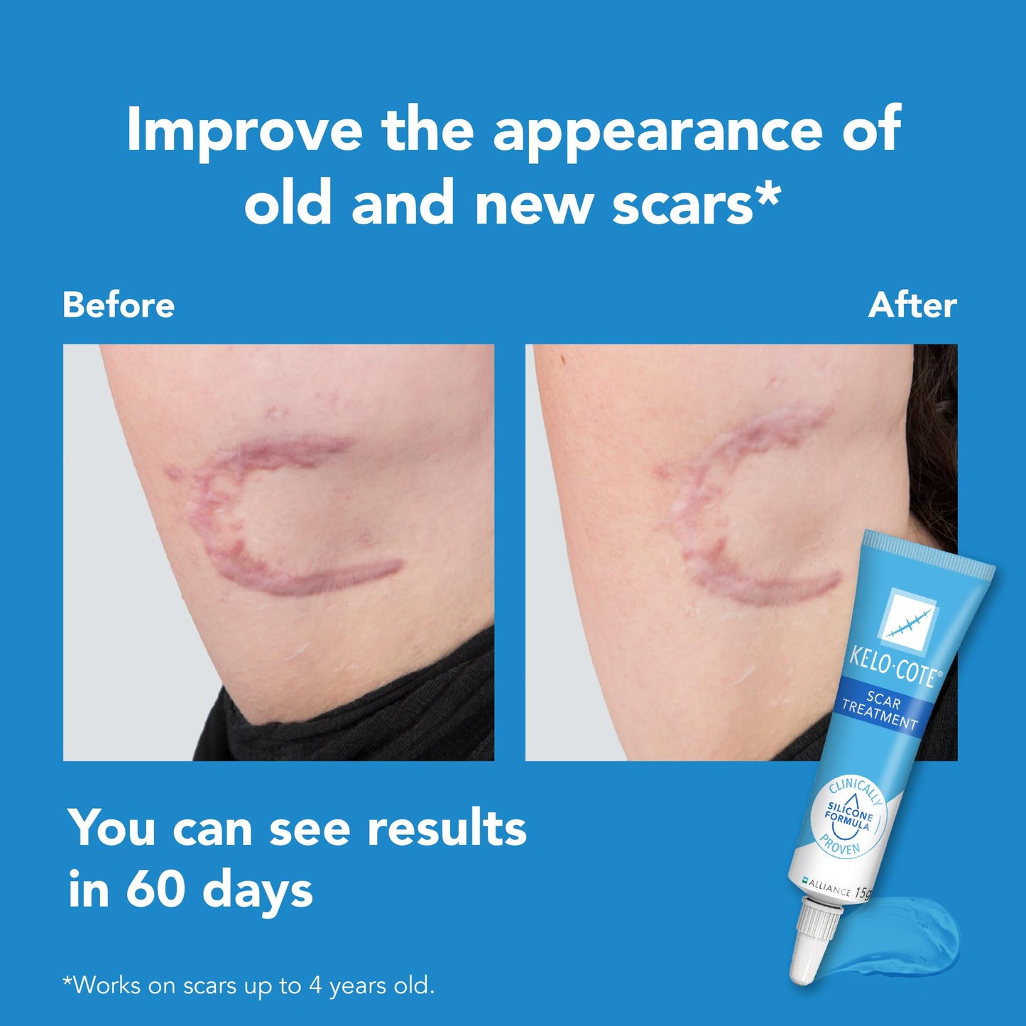 Kelo-Cote Gel for Scars 6g by Kelo-Cote