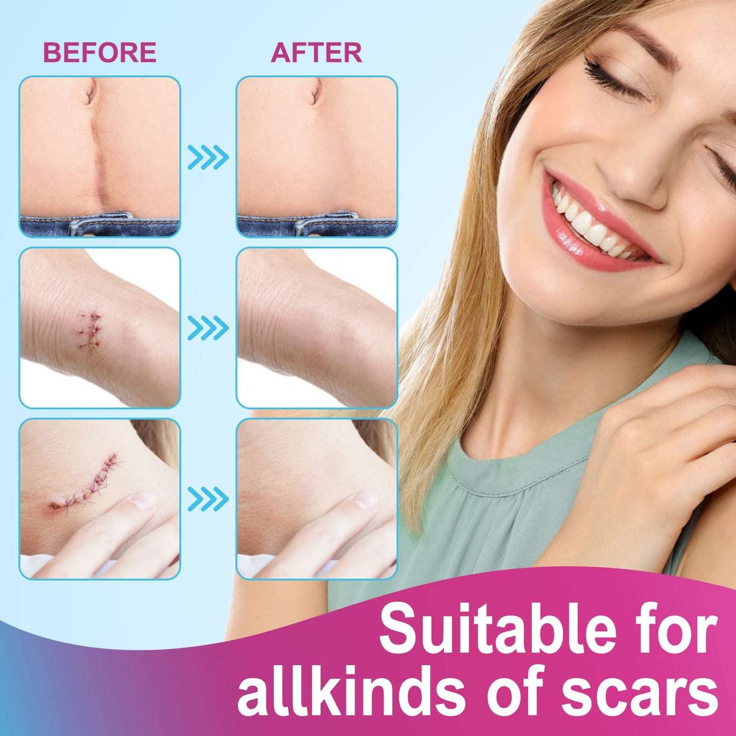Silicone Scar Sheets (1.6” x 75”-1.9M), Medical Grade Soft Silicone Scar Tape, Scar Strips, Scar Roll - Keloid, C-Section, Surgical, Acne- Scars Removal Treatment, Painless Easy Removal, Reusable