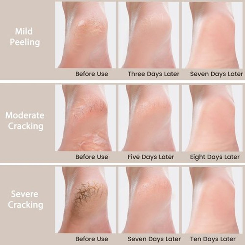 Urea Cream 40 Percent for Feet 5.29oz - Maximum Foot & Hand Cream, for Dry, Cracked Heels, Feet, Knees, Elbows, and Hands,Callus Remover, Strength Urea Lotion for Softening and Moisturizing