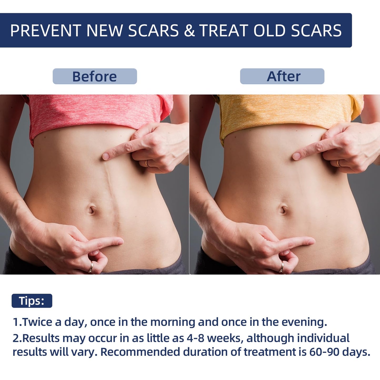 Silicone Scar Gel, Scar Cream for Face & Body, Advanced Scar Cream Gel for Old & New Scars, Stretch Marks, Surgery, Burns, C-Section 30g (1.06 Oz)