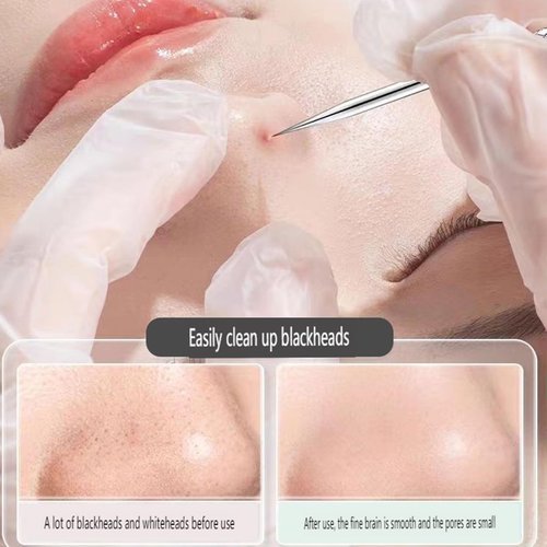 Usiveinborn Blackhead Remover, Usiveinborn Tweezers, Professional Facial Blackhead Remover Tweezers, Stainless Steel Blackhead Tweezers Professional Tool Set, Blackhead/Pimple Extracto (3PCS)