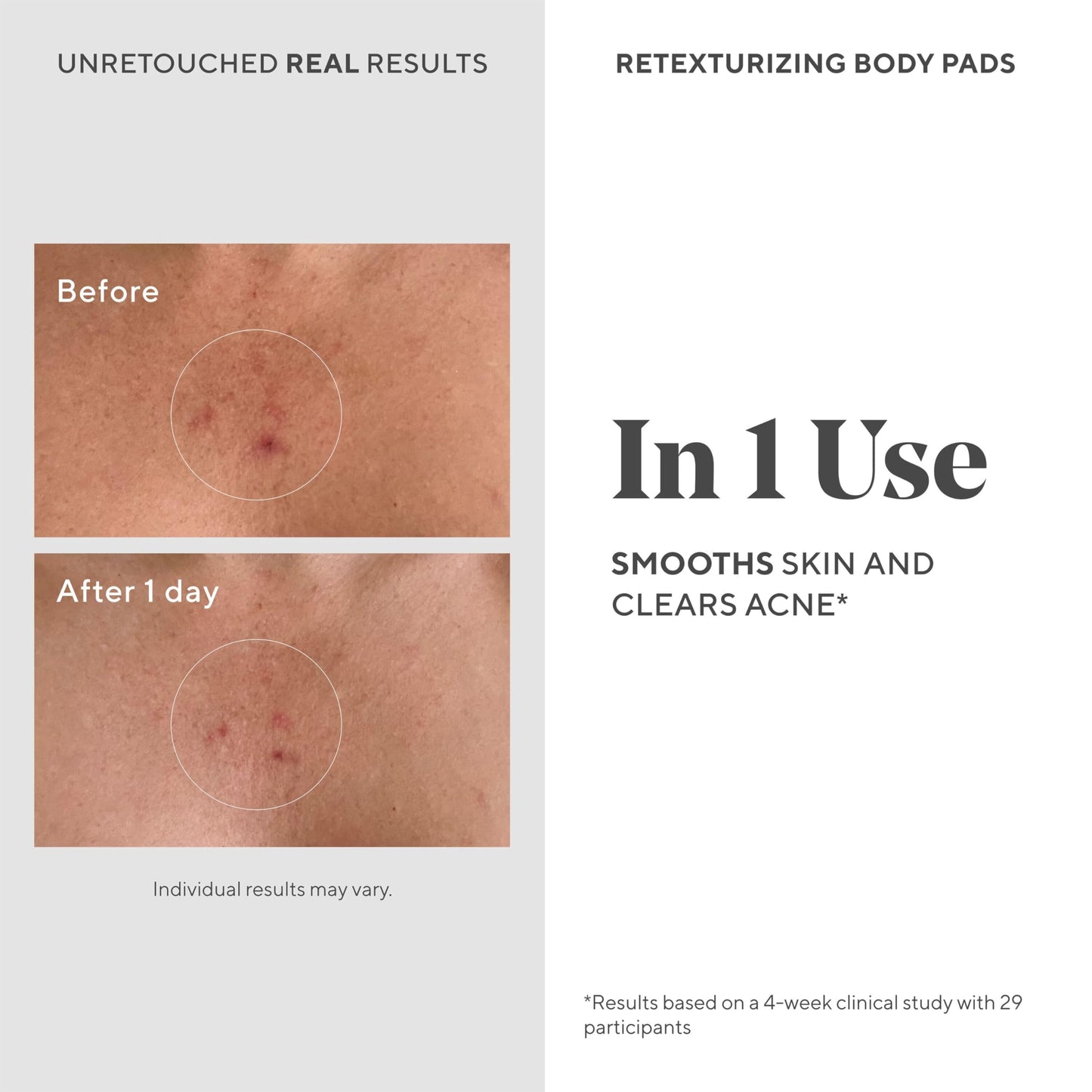 Murad Acne Body & Spot Correcting Combo - Retexturizing Body Pads and Rapid Dark Spot Correcting Serum for Clearing Breakouts and Hyperpigmentation, Set of 2