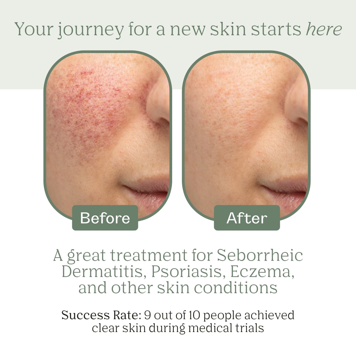 Dermabon Seborrheic Dermatitis Cream, Eczema & Psoriasis Treatment - Calendula Extract, Salicylic Acid, Bee Wax - Soothes, Hydrates & Balances Skin Tone - Moisturizing & Skin Relaxing Relief