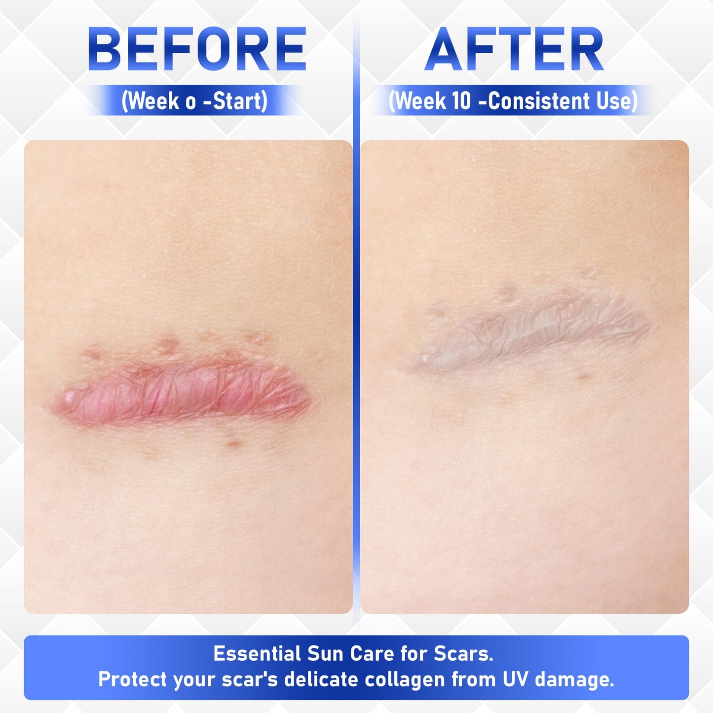 Crobirware Silicone Scar Cream Gel - [3.53 oz / 100g] Jumbo Value Pack - Advanced Gel for Old & New Scars, C-Section, Stretch Marks, Surgery, Acne, Burns, Keloids - Face & Body