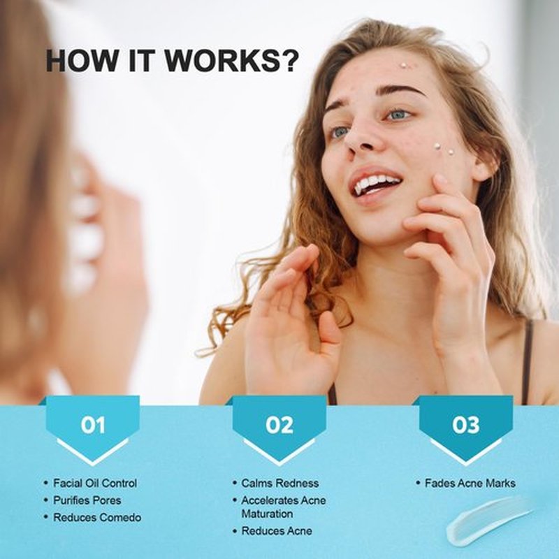 Cystic Acne Spot Treatment Cream for Face, Back and Body, with 10% Azelaic Acid & 2% Salicylic Acid, Hormonal Pimple Moisturizer for Teens & Adults, Relief Breakouts Redness Swelling, 1.8 oz