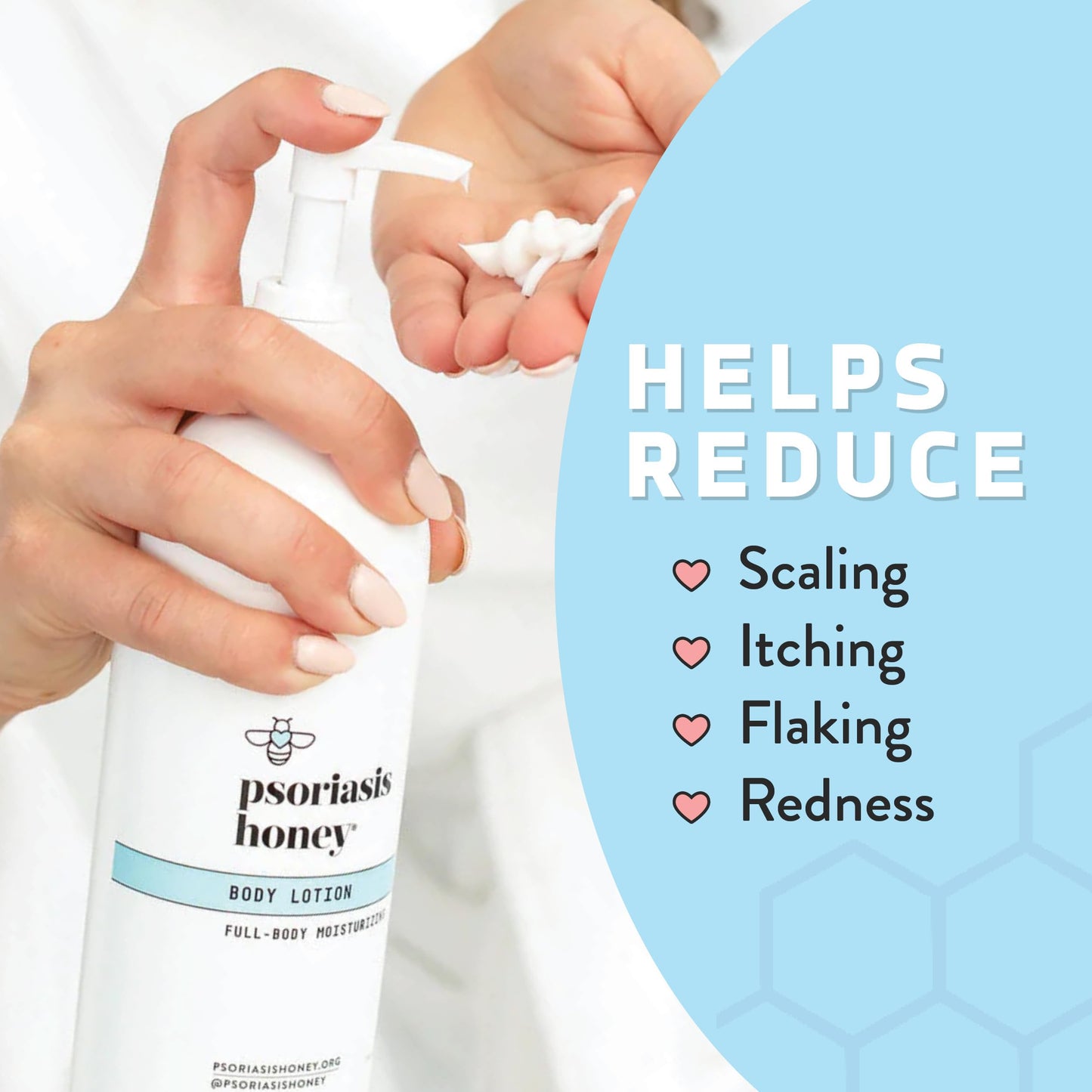 PSORIASIS HONEY Daily Moisturizing Body Lotion, for Itching Skin (16 oz)