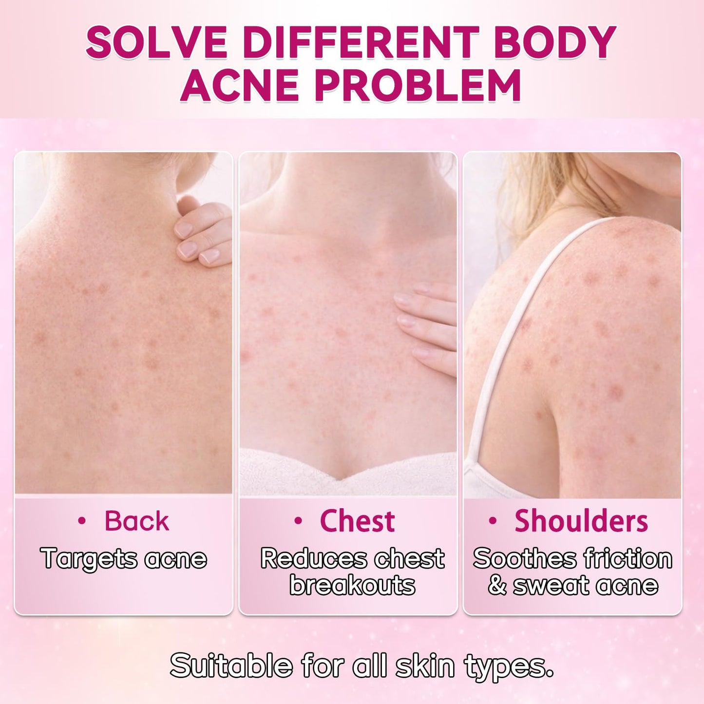 2% Salicylic Acid Spray, 360°Acne Spray, Targets Blemishes, Blackheads, Reduces Body Breakouts, Pore Clarifying, Ideal for Back, Chest, Shoulders, All Skin Types, 5.07 fl.oz