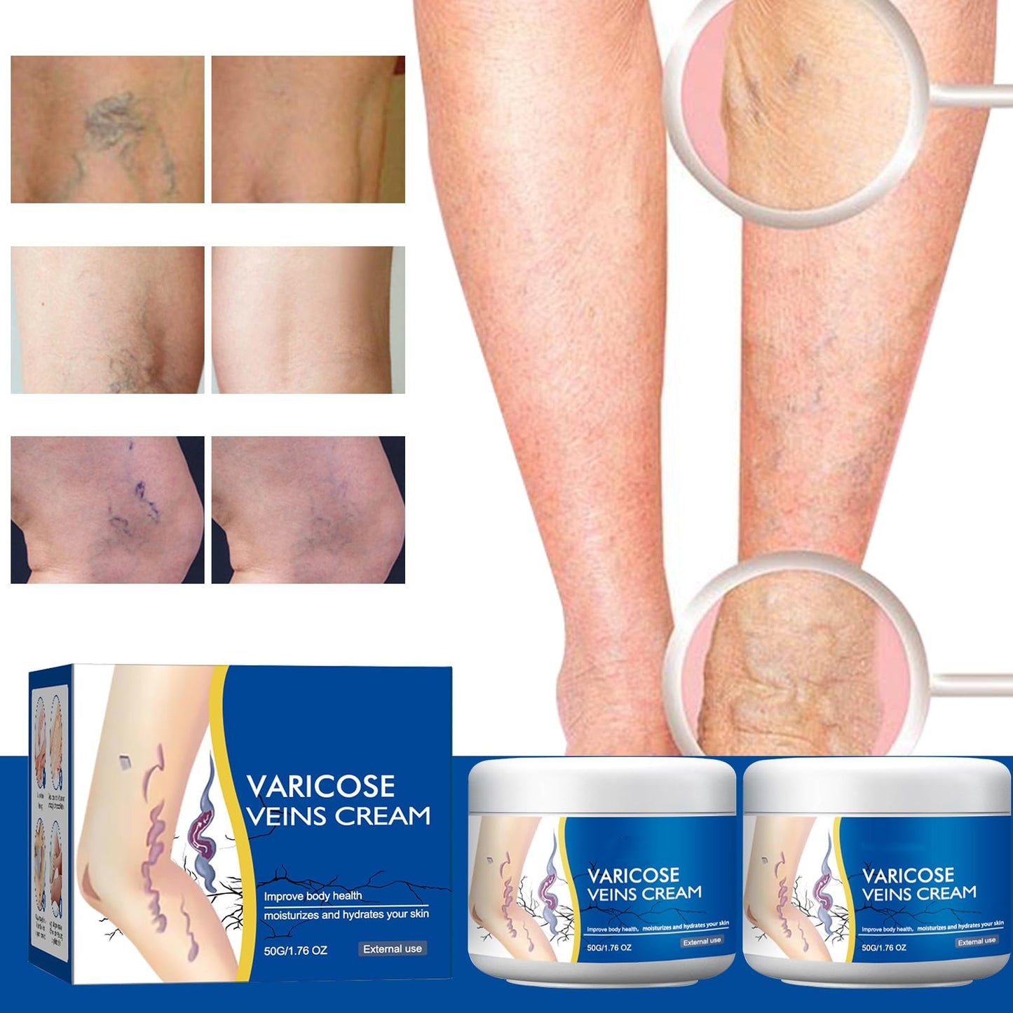 2Pcs Varicose Veins Treatment Cream for Legs Natural Ingredients, Suitable for Most Skin Types
